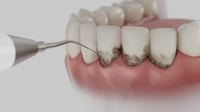 Trusted Wisdom Tooth Removal service in Middletown, OH - Dentist Open Now